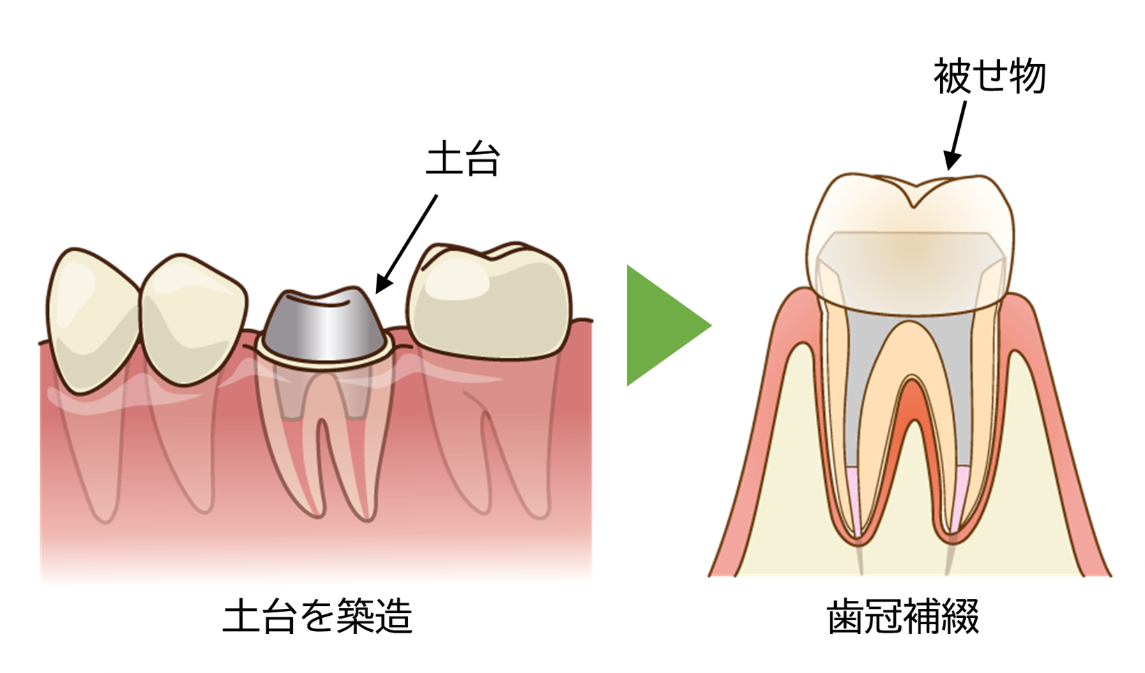 ④土台をたてて歯を作る処置