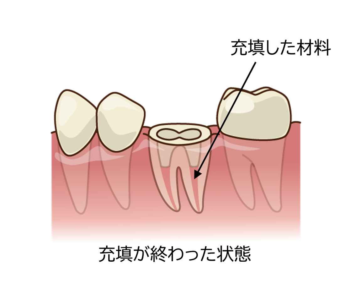 ③充填完了