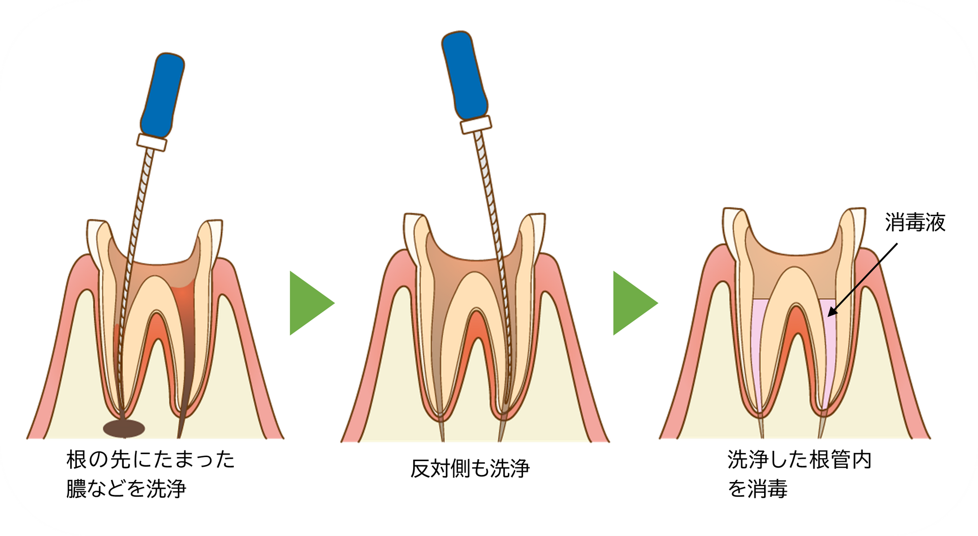 ②根管内の洗浄