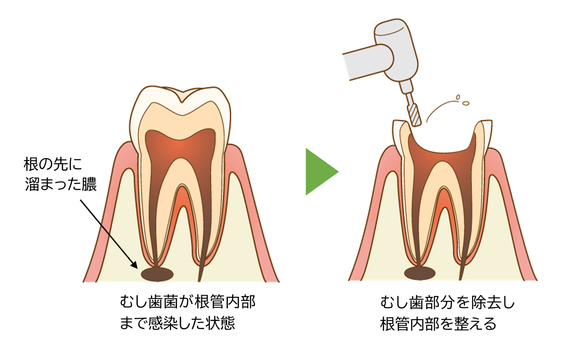 ➀むし歯菌の除去