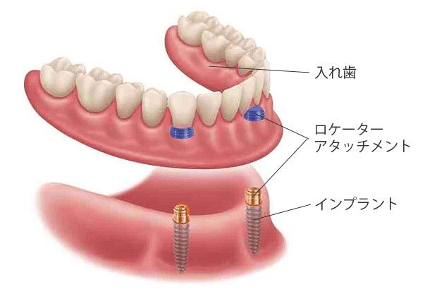 インプラントオーバーデンチャーの図1
