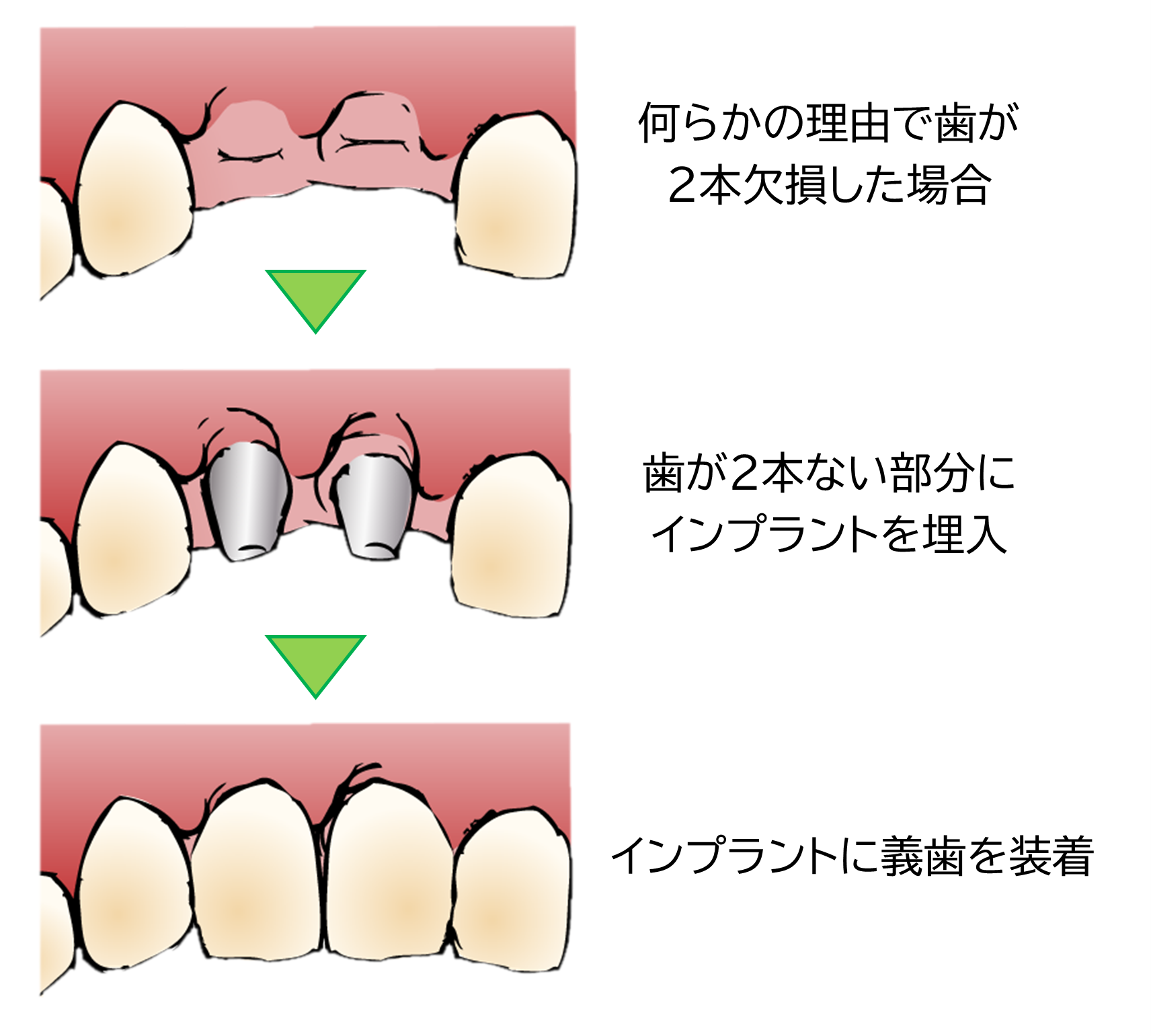 インプラント治療方法