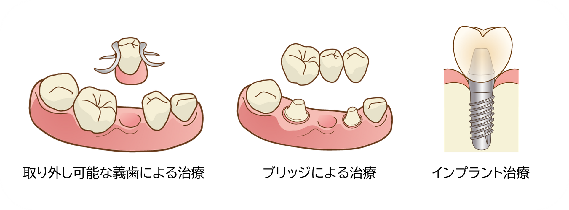 インプラント治療以外の治療法