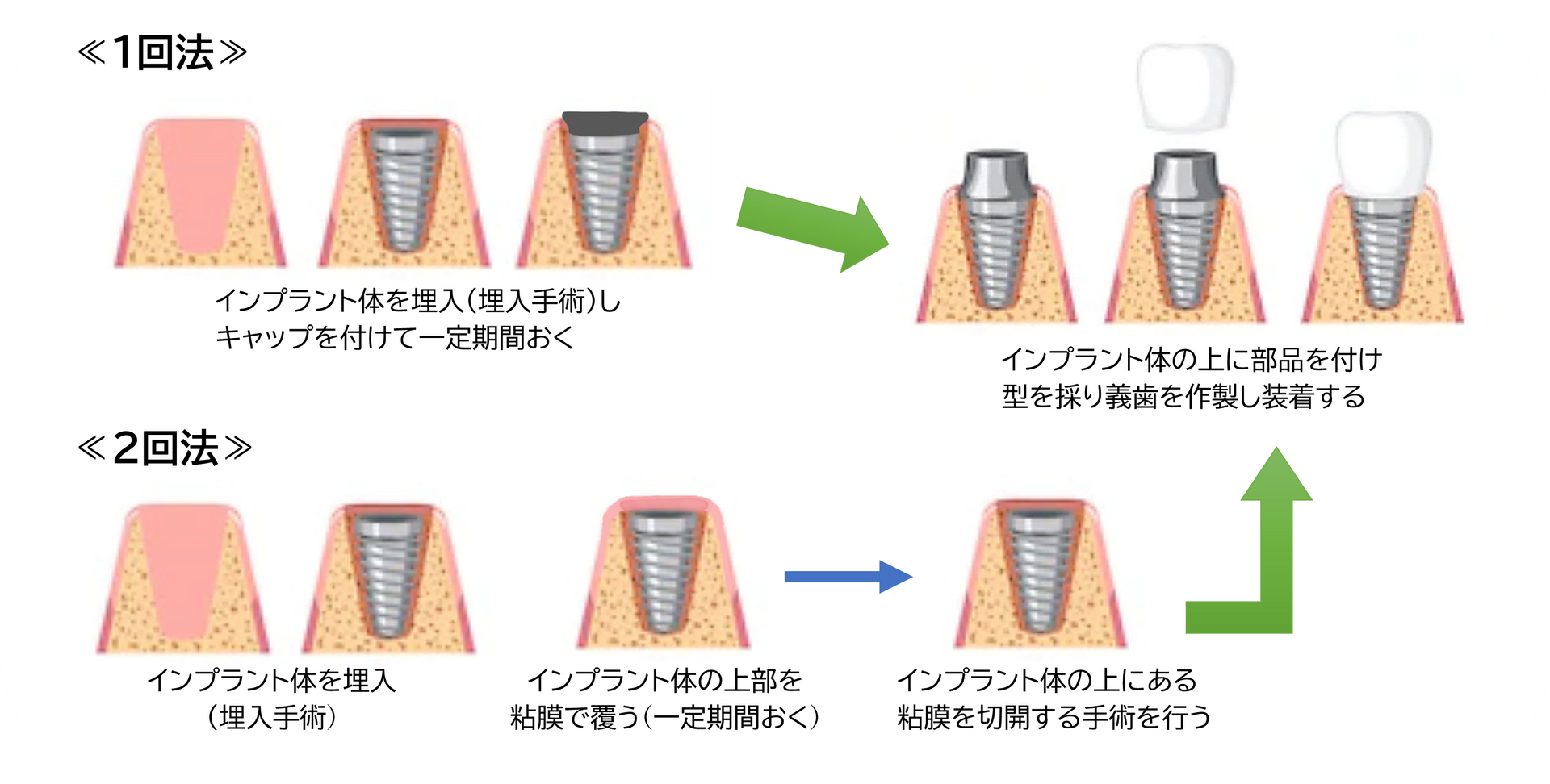 1回法と2回法の違い