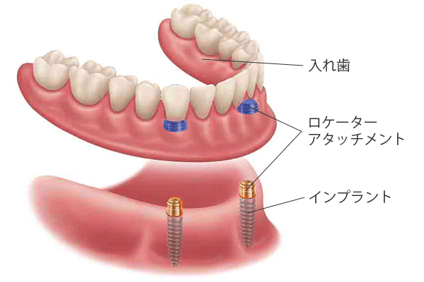 インプラントオーバーデンチャーの図