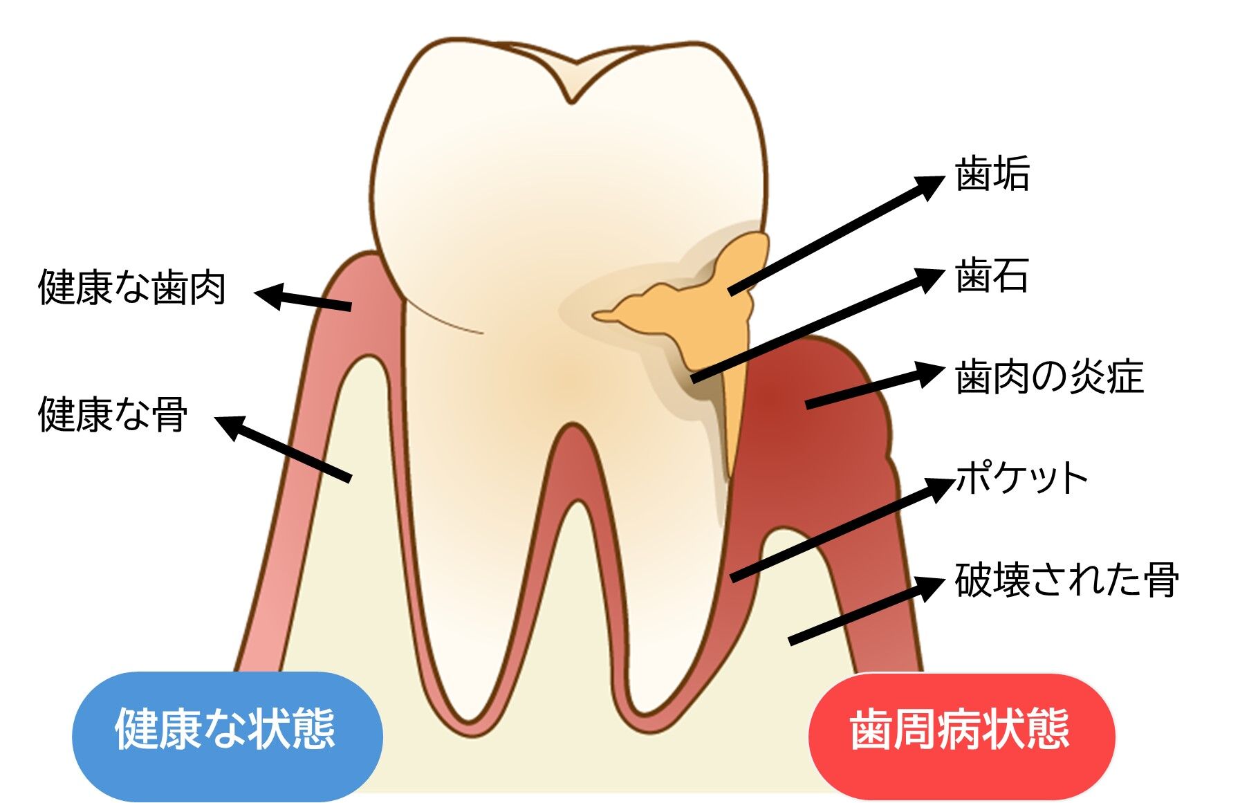 歯周病の図